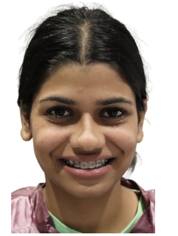 After treatment