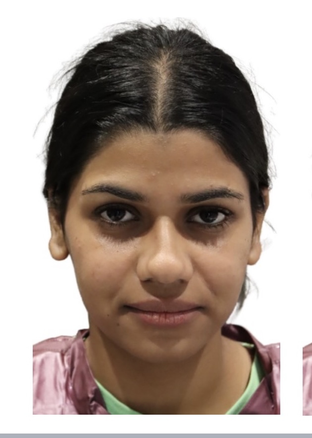 Before treatment