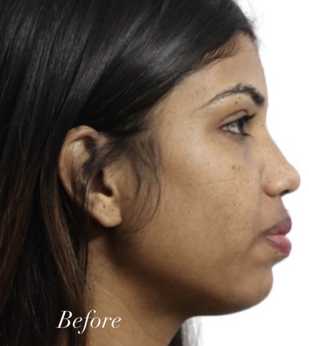 Before treatment