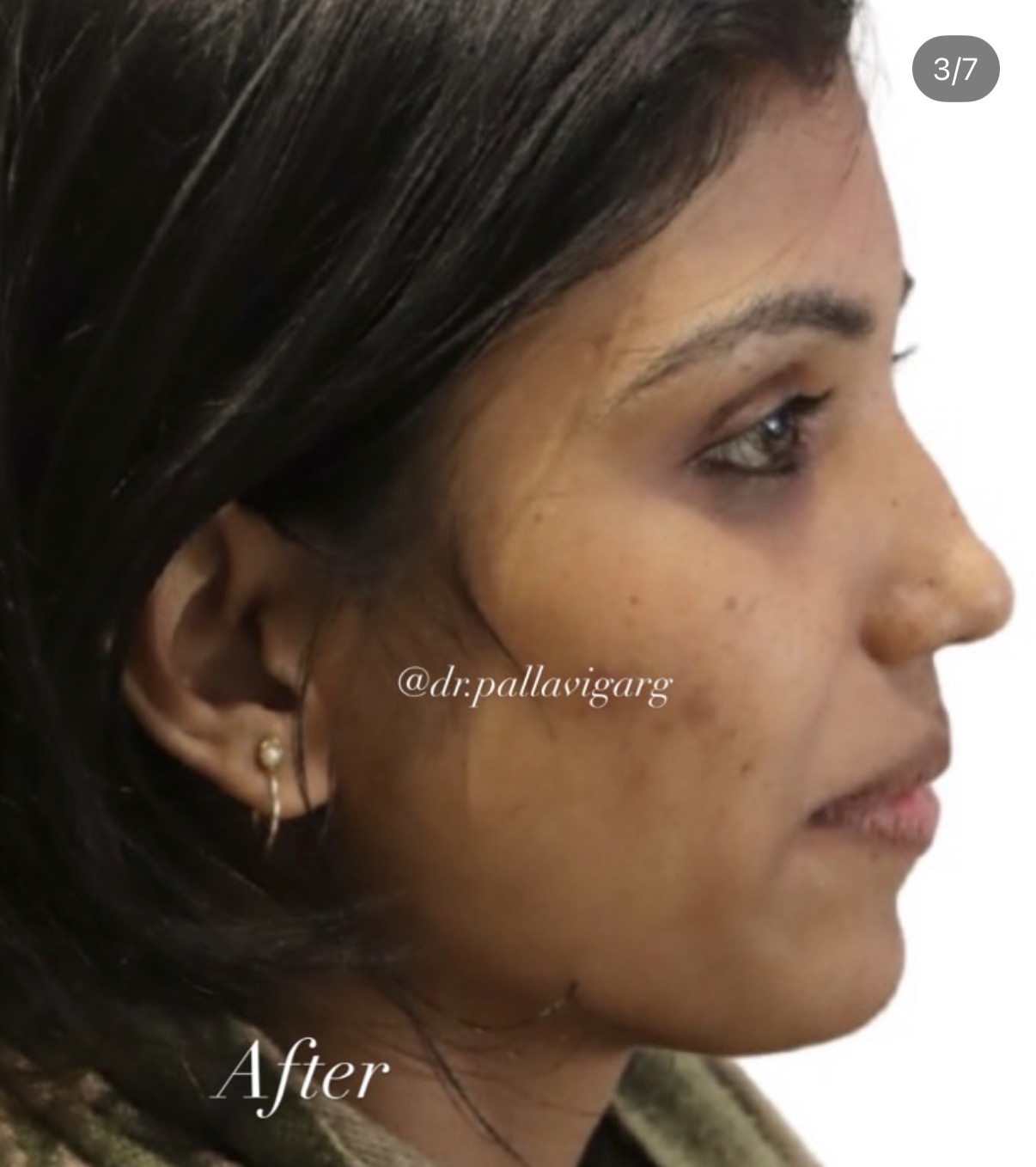 After treatment